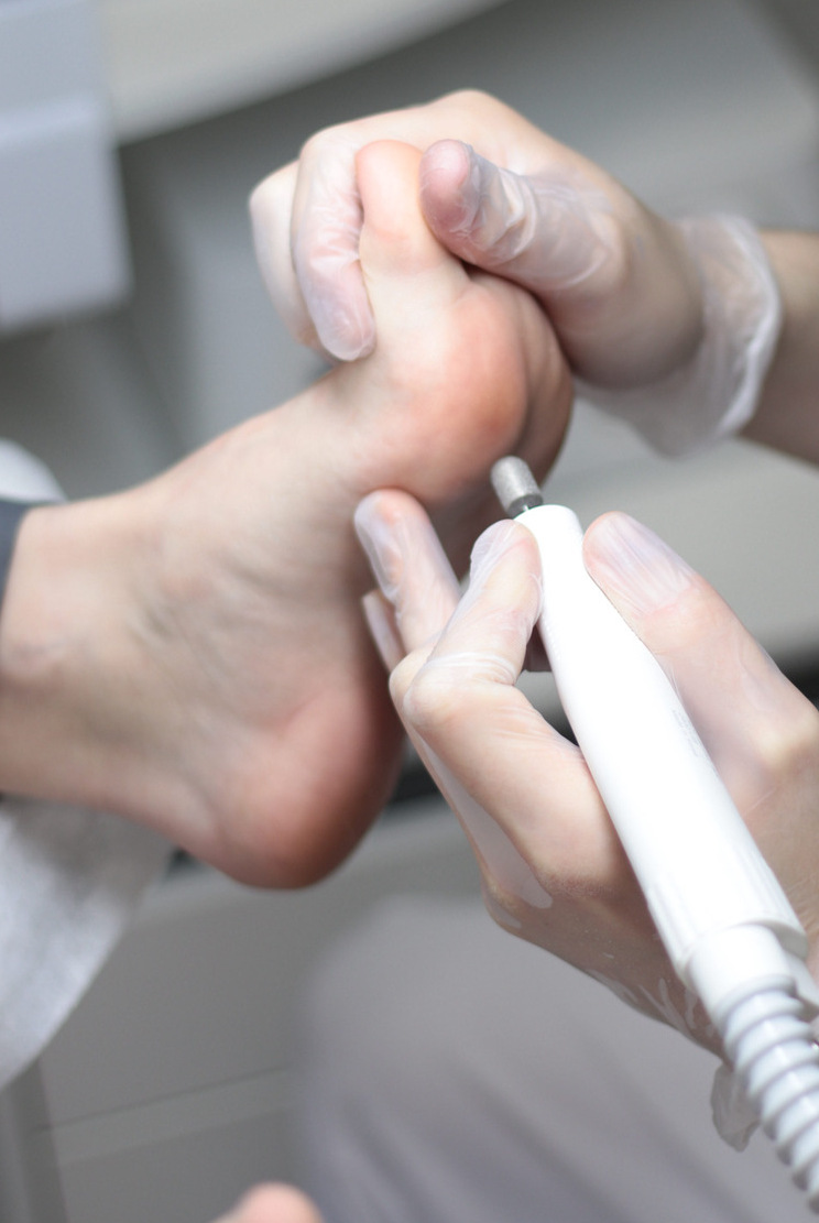 <span style="font-weight: bold;">Мозоли</span>